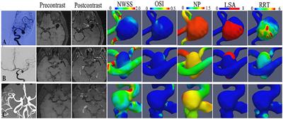 Hemodynamic Characteristic Analysis of Aneurysm Wall Enhancement in Unruptured Middle Cerebral Artery Aneurysm